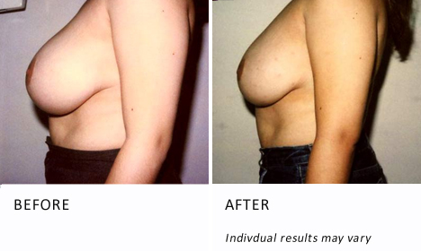 Side Breast Tissue Removal Before and After