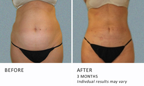 Abdominal liposuction before and after
