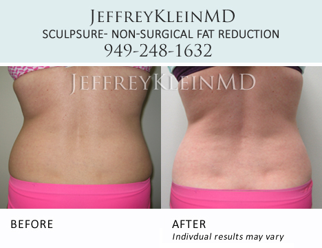 SculpSure - Body Contouring in Orange County - KleinLipo - Liposuction  Surgery of Orange County