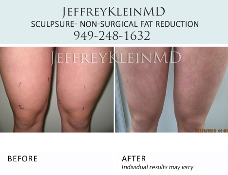 Jeffklein-sculpsure-anteriorknees_female