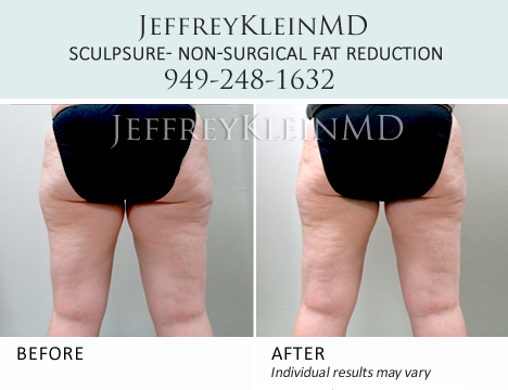 SculpSure - Body Contouring in Orange County - KleinLipo - Liposuction