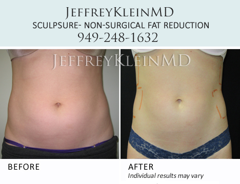 Jeffklein-sculpsure-abs-female DK