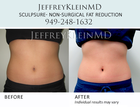 SculpSure - Body Contouring in Orange County - KleinLipo - Liposuction  Surgery of Orange County