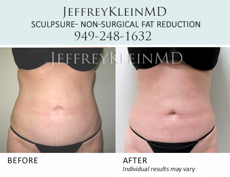 SculpSure - Body Contouring in Orange County - KleinLipo - Liposuction  Surgery of Orange County