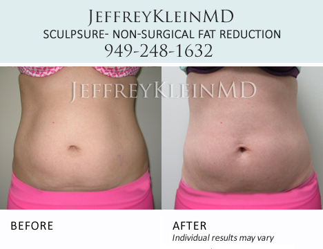 Liposuction vs. SculpSure Orange County, Body Contouring Irvine, CA