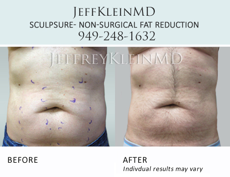 Jeffklein-sculpsure-abs-male