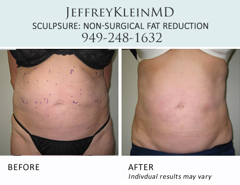 Jeffklein-sculpsure-abs-pa2b