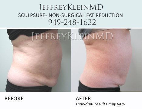 Liposuction vs. SculpSure Orange County, Body Contouring Irvine, CA