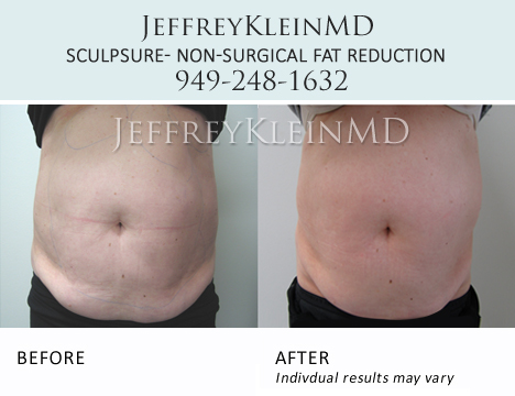 Jeffklein-sculpsure-abs-pa3b