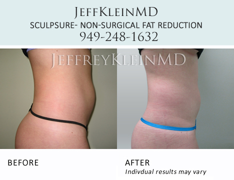 Jeffklein Sculpsure Abs Sideview Female