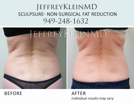 Jeffklein-sculpsure-back-RH