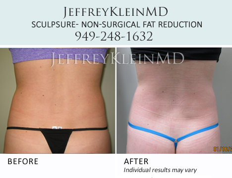 Jeffklein-sculpsure-back-female DK