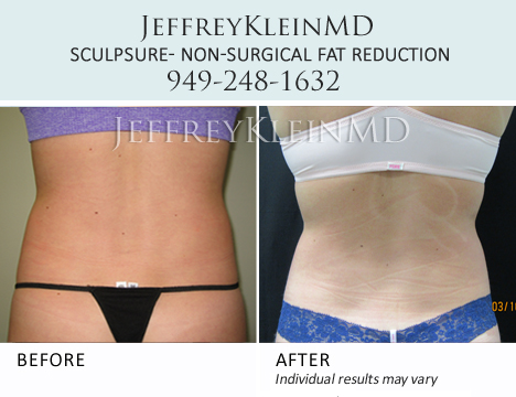 Jeffklein-sculpsure-back Female DK2