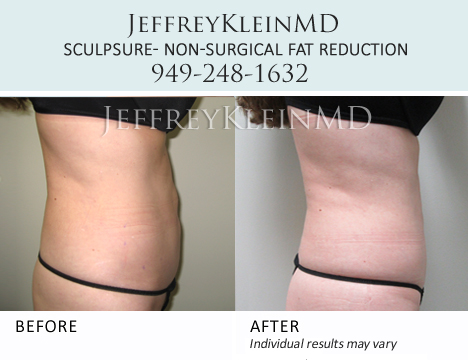 Jeffklein-sculpsure-flanks-female-patient