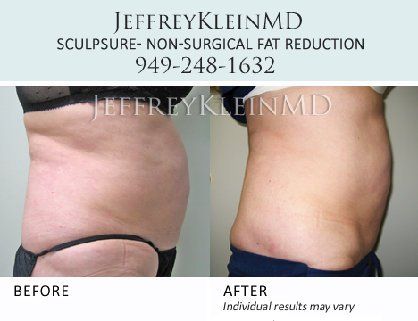 Jeffklein-sculpsure-upperabs-female-patient