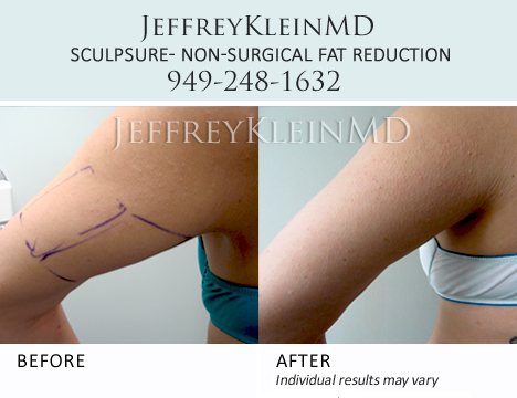 Sculpsure-arms-female-patient