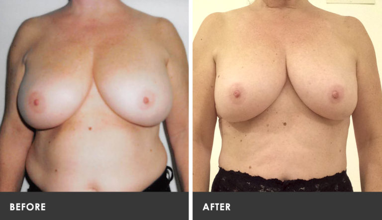 Scarless Breast Reduction