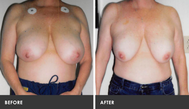 Scarless Breast Reduction