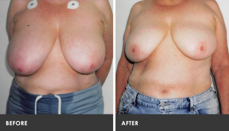 Scarless Breast Reduction