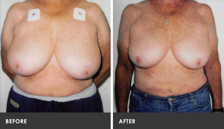 Scarless Breast Reduction