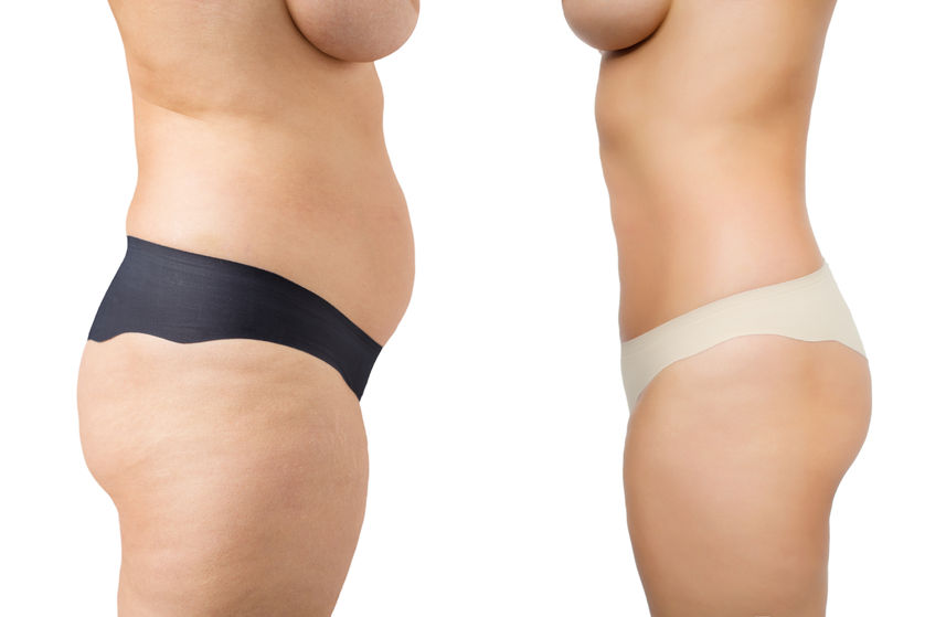 Sculpsure Body Contouring Vs Liposuction