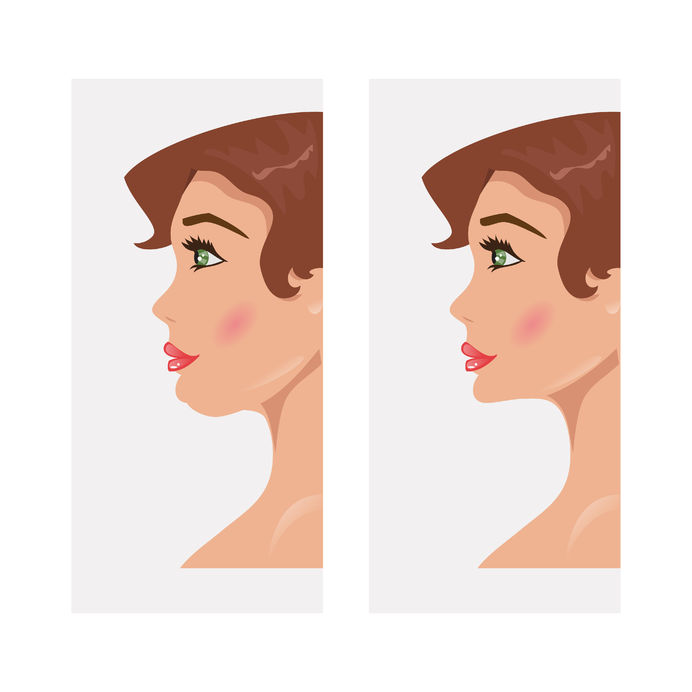 Kybella Vs. Liposuction