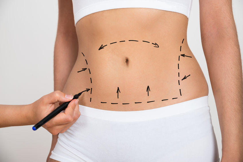 If You Have Been Considering Liposuction, Read This