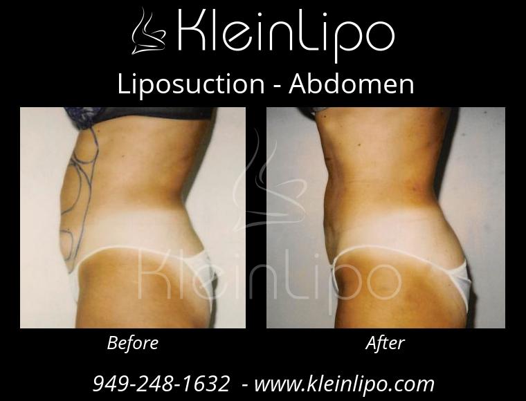 Liposuction-Abdomen-2-27-2018-16-54-10