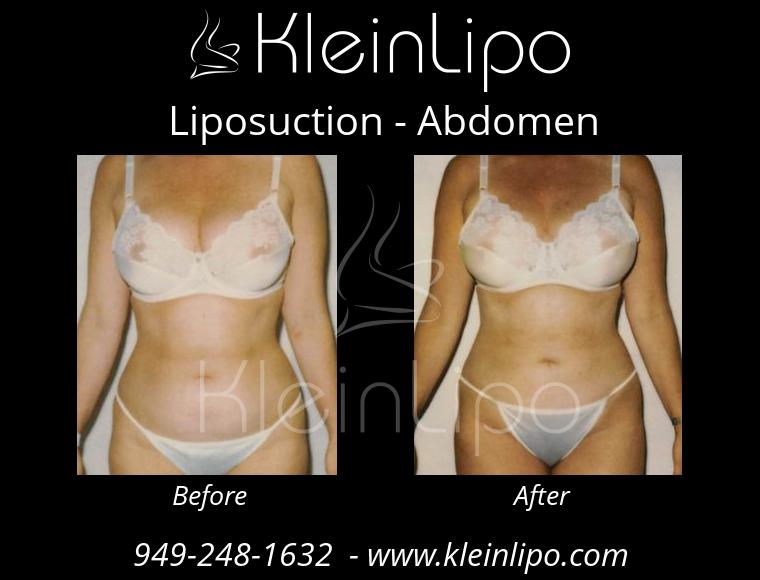 Liposuction-Abdomen-2-27-2018-16-54-11