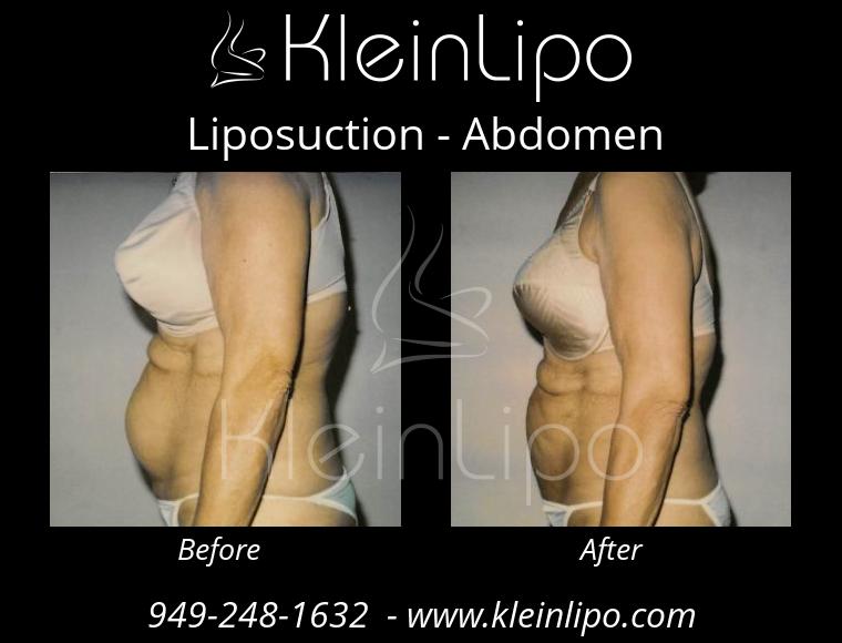 Inner Thighs Liposuction - KleinLipo - Liposuction Surgery of Orange County