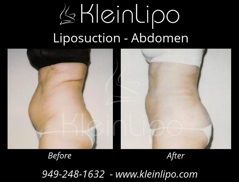 Liposuction-Abdomen-2-27-2018-16-54-30