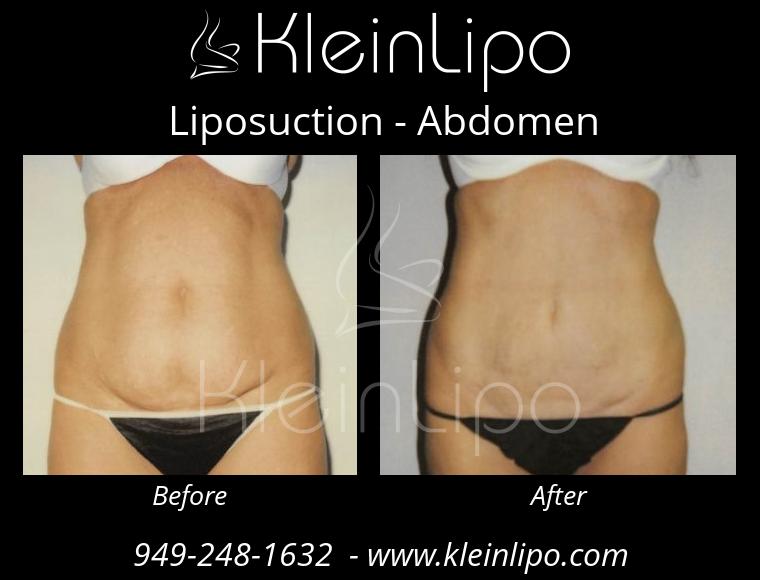 Liposuction Abdomen 2 27 2018 16 54 32