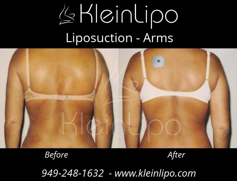 Liposuction-Arms-2-27-2018-16-52-46