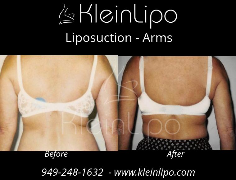 Liposuction-Arms-2-27-2018-16-52-49