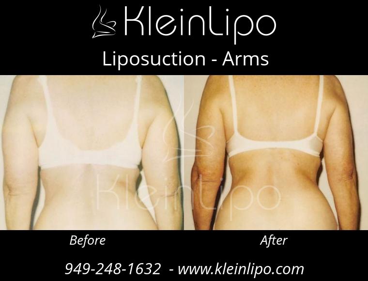 Liposuction-Arms-2-27-2018-16-52-55