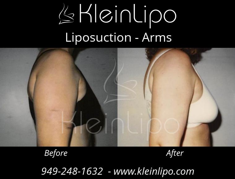 Liposuction-Arms-2-27-2018-16-52-56