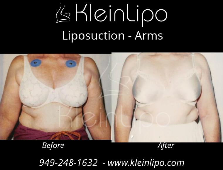 Liposuction-Arms-2-27-2018-16-52-57