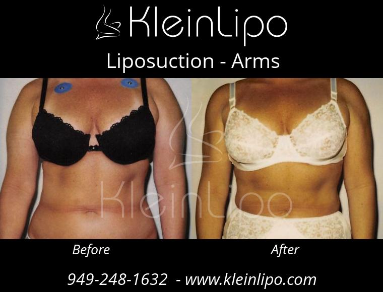 Liposuction-Arms-2-27-2018-16-53-01