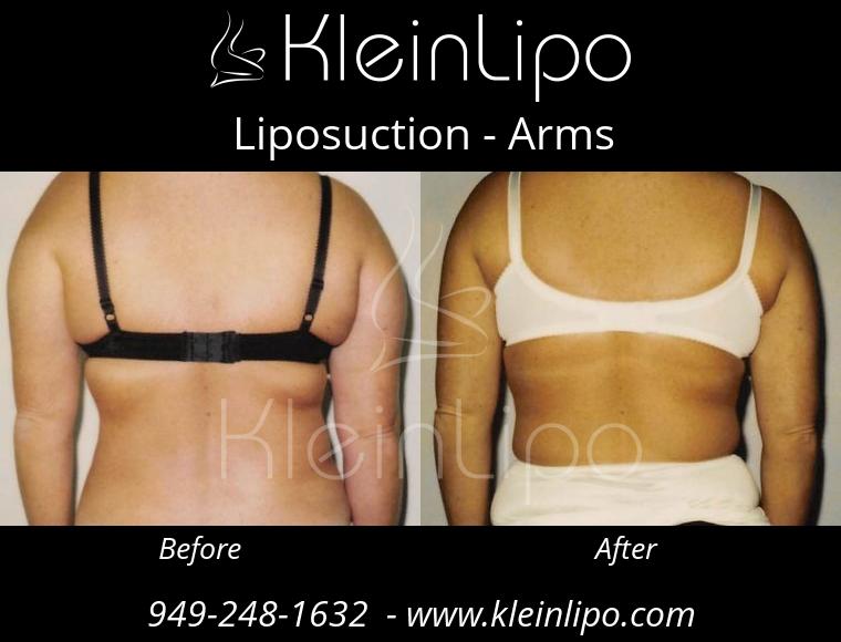 Liposuction-Arms-2-27-2018-16-53-03