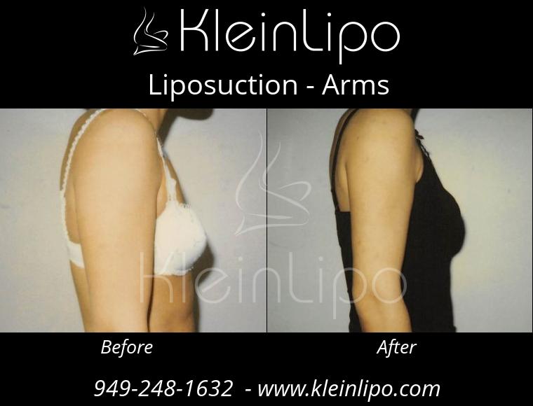 Liposuction Arms 2 27 2018 16 53 18