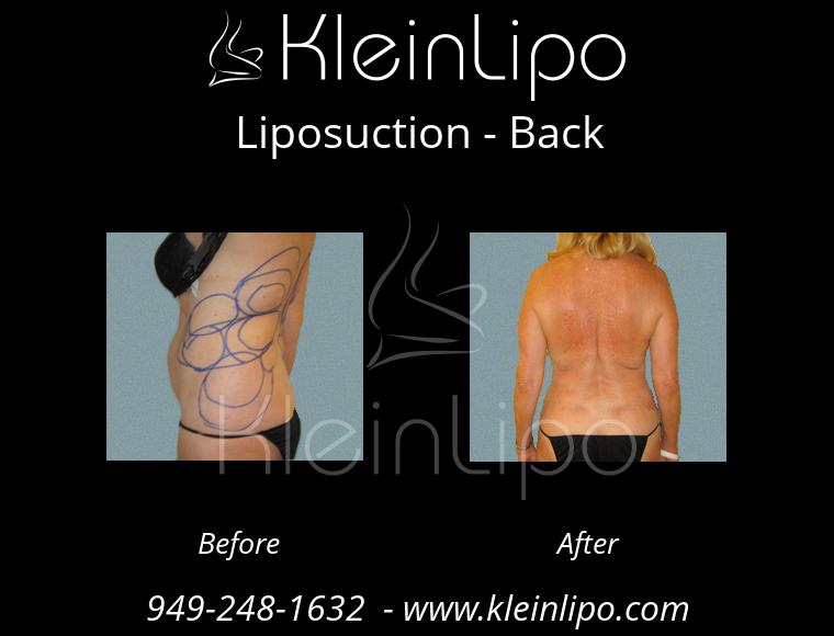 Liposuction Before After Photos, Palm Desert