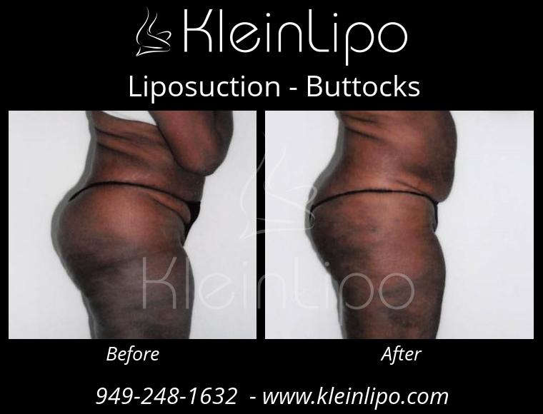 Liposuction-Buttocks-2-27-2018-16-51-58