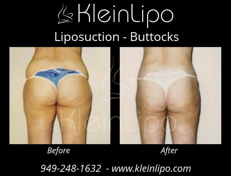 Liposuction Buttocks 2 27 2018 16 52 03