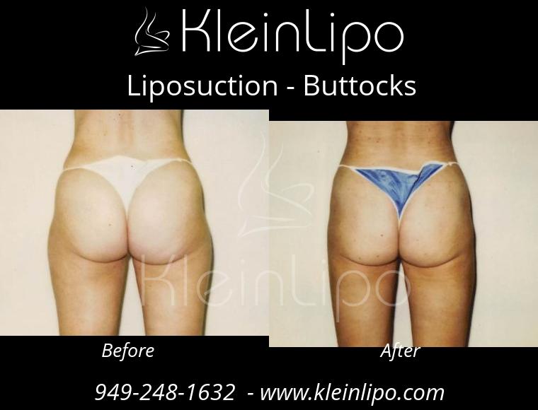 Liposuction Buttocks 2 27 2018 16 52 05