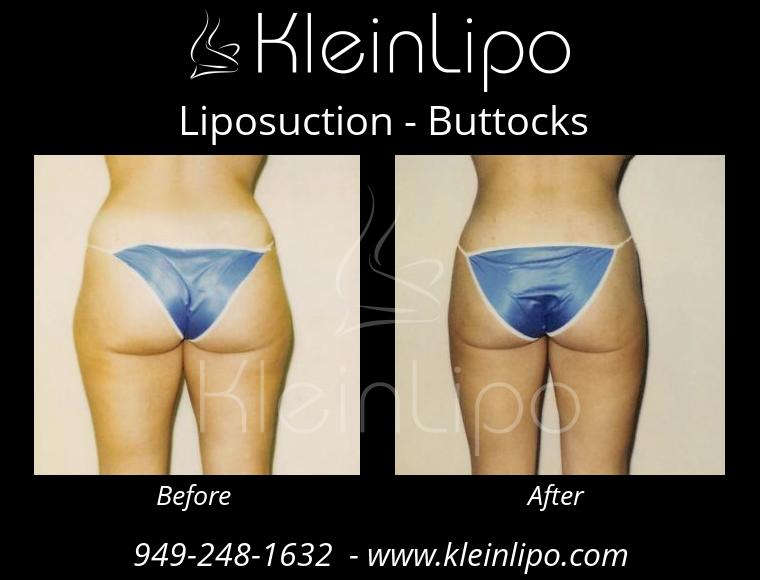 Liposuction-Buttocks-2-27-2018-16-52-13