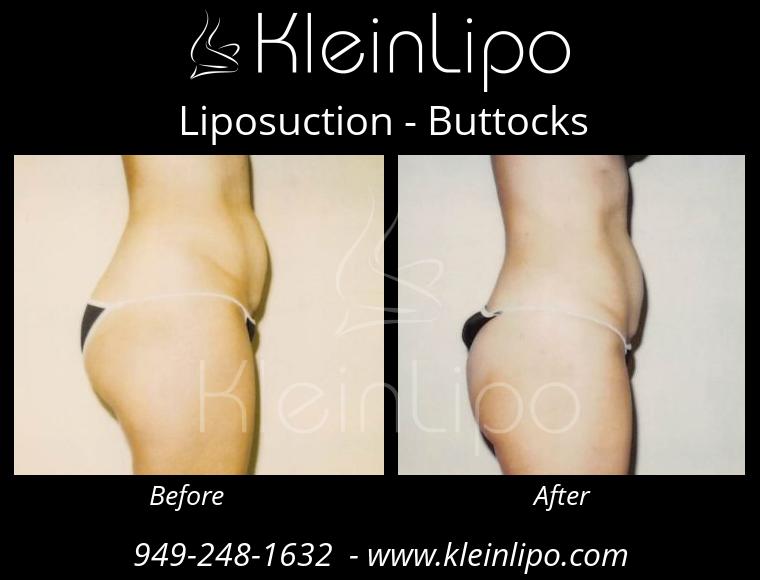 Liposuction Buttocks 2 27 2018 16 52 16