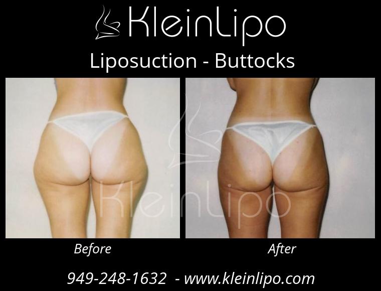 Liposuction-Buttocks-2-27-2018-16-52-24