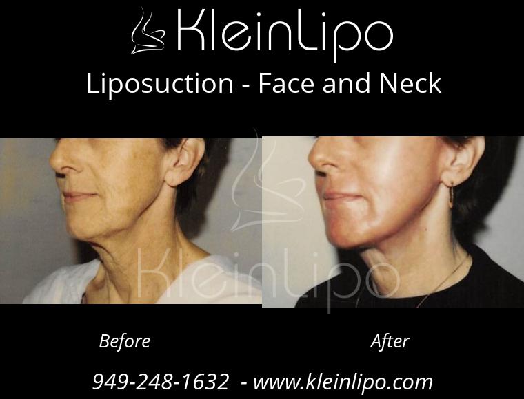 Liposuction FaceandNeck 2 28 2018 11 42 48