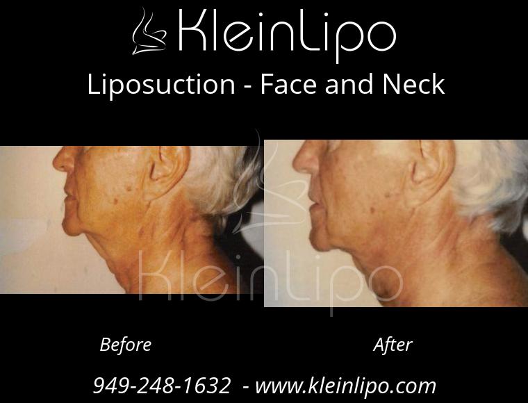 Liposuction-FaceandNeck-2-28-2018-11-42-51