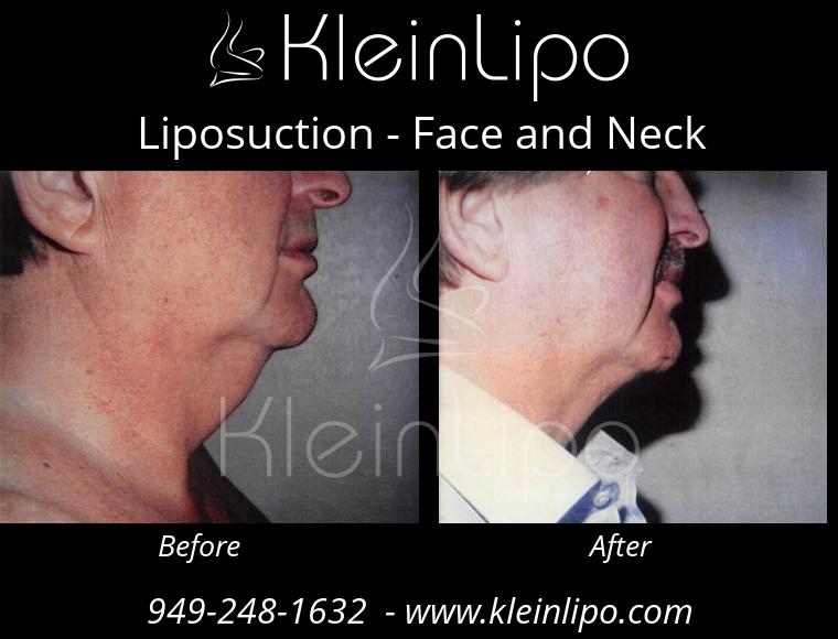 Inner Thighs Liposuction - KleinLipo - Liposuction Surgery of Orange County